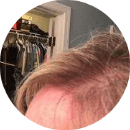 Hair loss close up