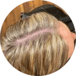 Female Hair Loss